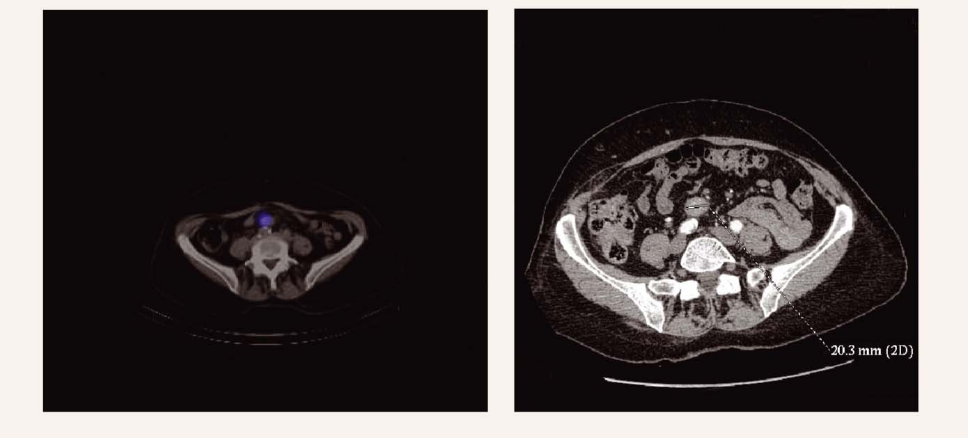 Somatostatīna receptoru scintigrāfija/DT –  primārais tumors aortas bifurkācijas līmenī