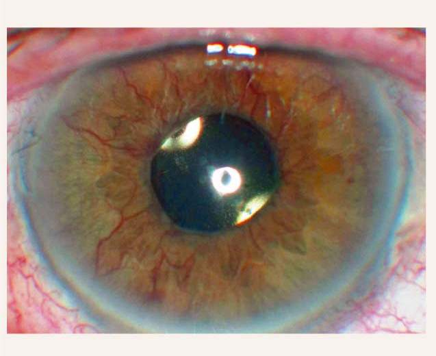 Diabētiskā retinopātija un redzes funkcijas
