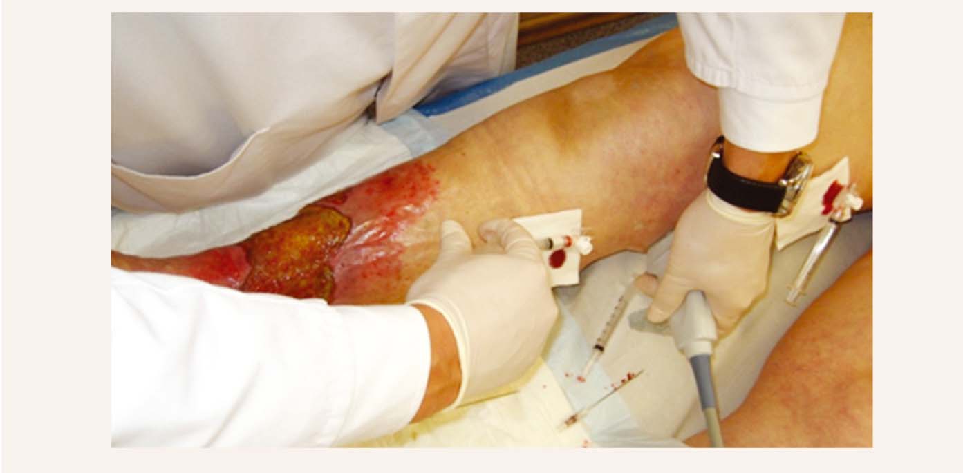 Stumbra vēnas putu skleroterapija duplekssonogrāfijas kontrolē pacientam ar Vena saphena magna stumbra varikozi C6 (vaļēja trofiska čūla)