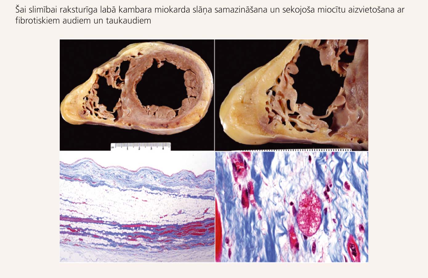 Makroskopisks (augšējie preparāti) un mikroskopisks  (apakšējie preparāti) sirds izskats pie ALKD