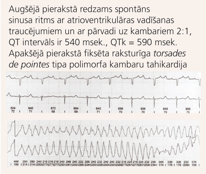 Holtera monitorēšanas pieraksts pacientei ar iedzimtu garā QT intervāla sindromu