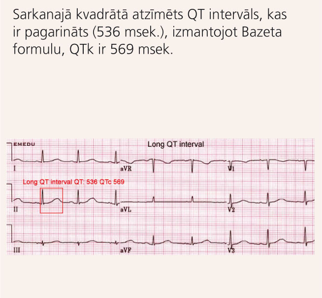 EKG pacientam ar iedzimtu pagarināta QT intervāla sindromu