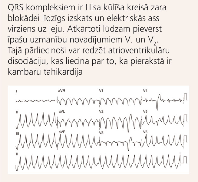 EKG ar ALKD raksturīgu monomorfu kambaru tahikardiju
