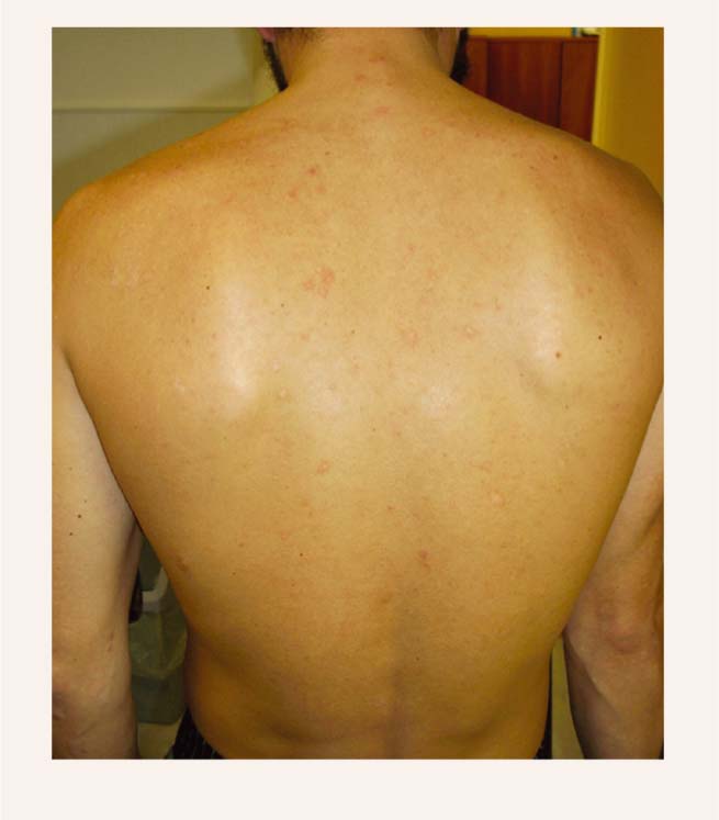 Seborejiskā dermatīta ādas bojājumi uz muguras
