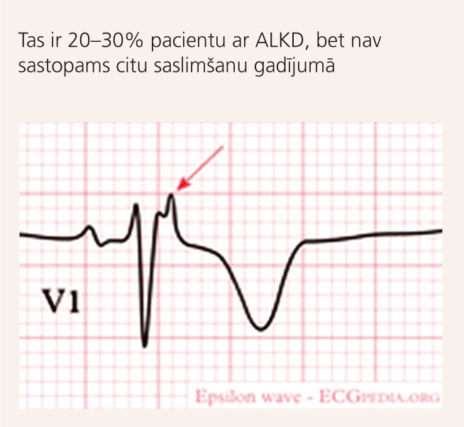 ALKD raksturīga pazīme EKG – “epsilona” vilnis