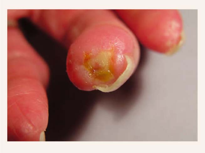 Sclerodermia sistēmiskā forma. Čūlas pirkstu galos, naga distrofiskas izmaiņas