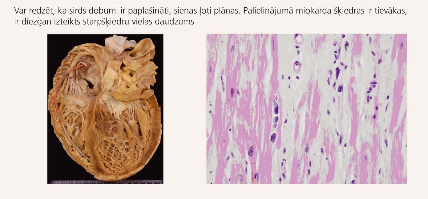 Makroskopisks (pa kreisi) un mikroskopisks (pa labi)  sirds izskats pie DKMP