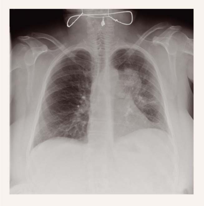 Pneimonija kreisās plaušas aksillārajā segmentā