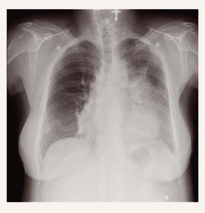 Pneimonija kreisās plaušas lingulārajos segmentos