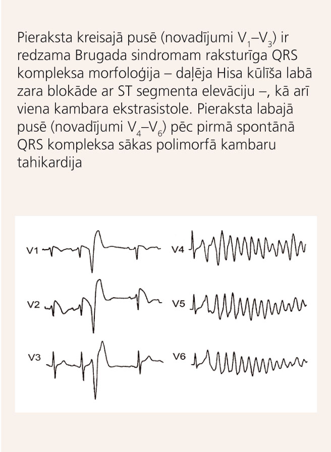 EKG pacientam ar Brugada sindromu