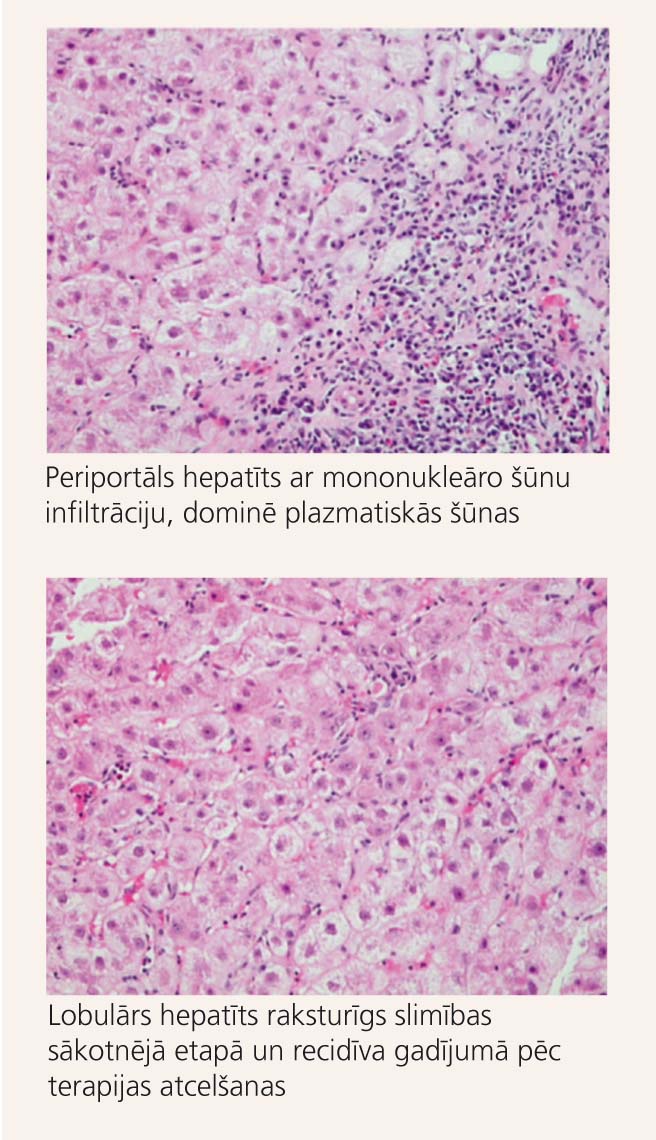 Autoimūna hepatīta  histoloģiskā aina [3]