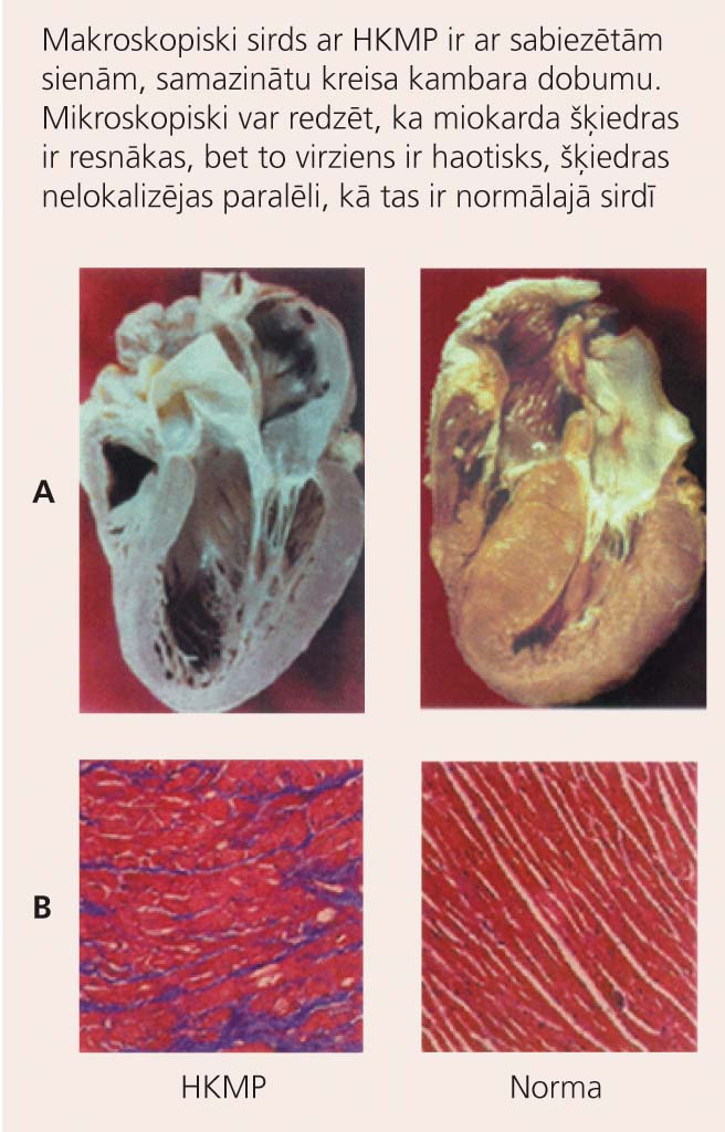 Makroskopisks (A) un mikroskopisks (B) sirds izskats pie HKMP  (pa kreisi) un veselā sirdī (pa labi)