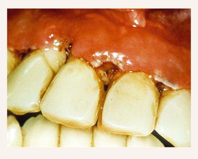 Nekrotisks ulcerozs periodontīts