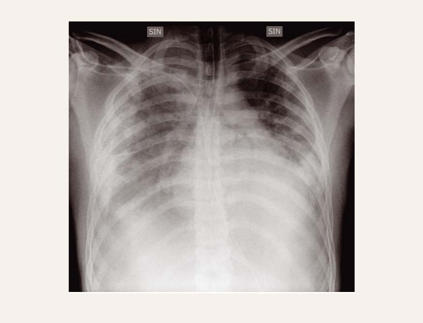 Krūškurvja rentgenogramma (20. oktobris)