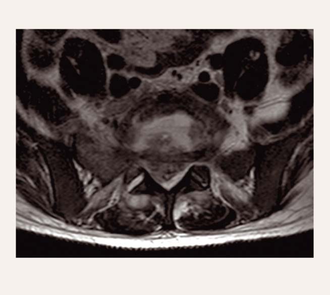 Pacients V. V. L6-S1  spondilodiscīts (MRI)