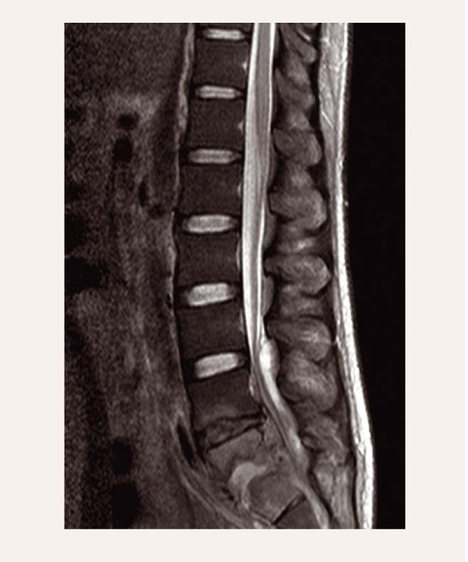 Pacients V. V. L6-S1  spondilodiscīts (MRI)