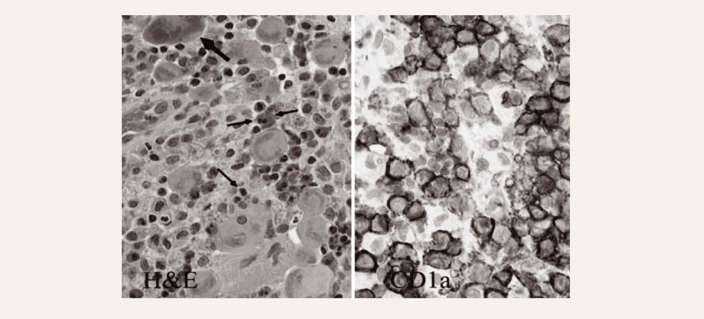 Langerhansa šūnu histiocitoze (H&amp;E pa kreisi; imūnhistoķīmija pa labi – CD1a)