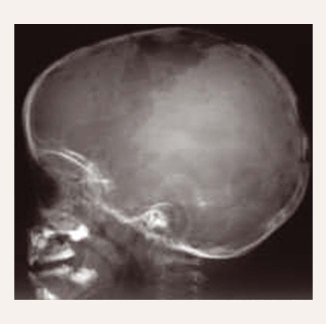 Galvaskausa kaulu izmaiņas pacientam ar Langerhansa šūnu histiocitozi