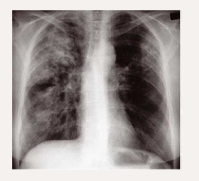 Plaušu rentgens pacientam  ar Čērga-Strosas sindromu