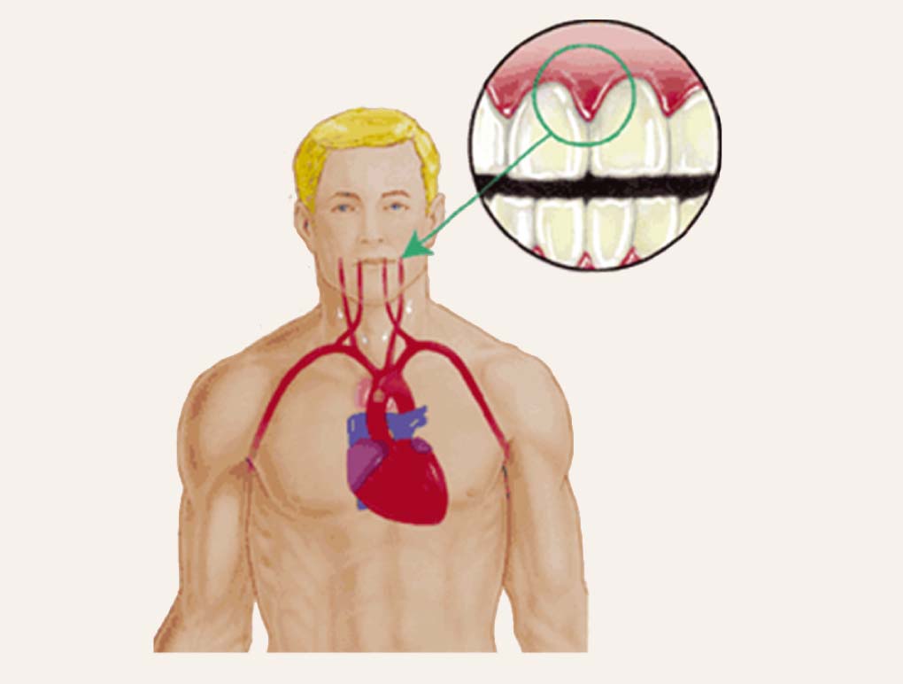 Parodontozes saistība ar sirds patoloģiju