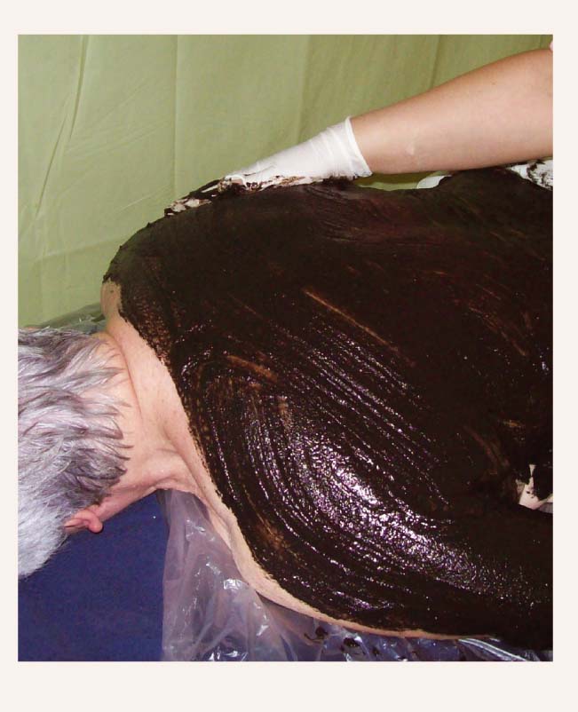 Ietīšana dūņās ar “peloīdu kompleksu” pie mugurkaulāja spondilozes, sievietei 76 gadi, procedūras sākumposms