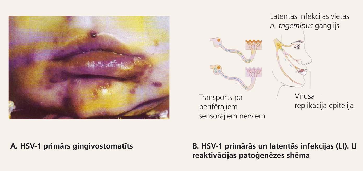 HSV-1 primārās un latentās infekcijas