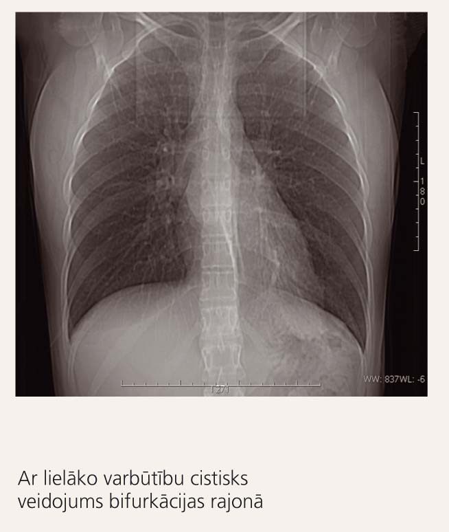 Plaušu rentgenogramma