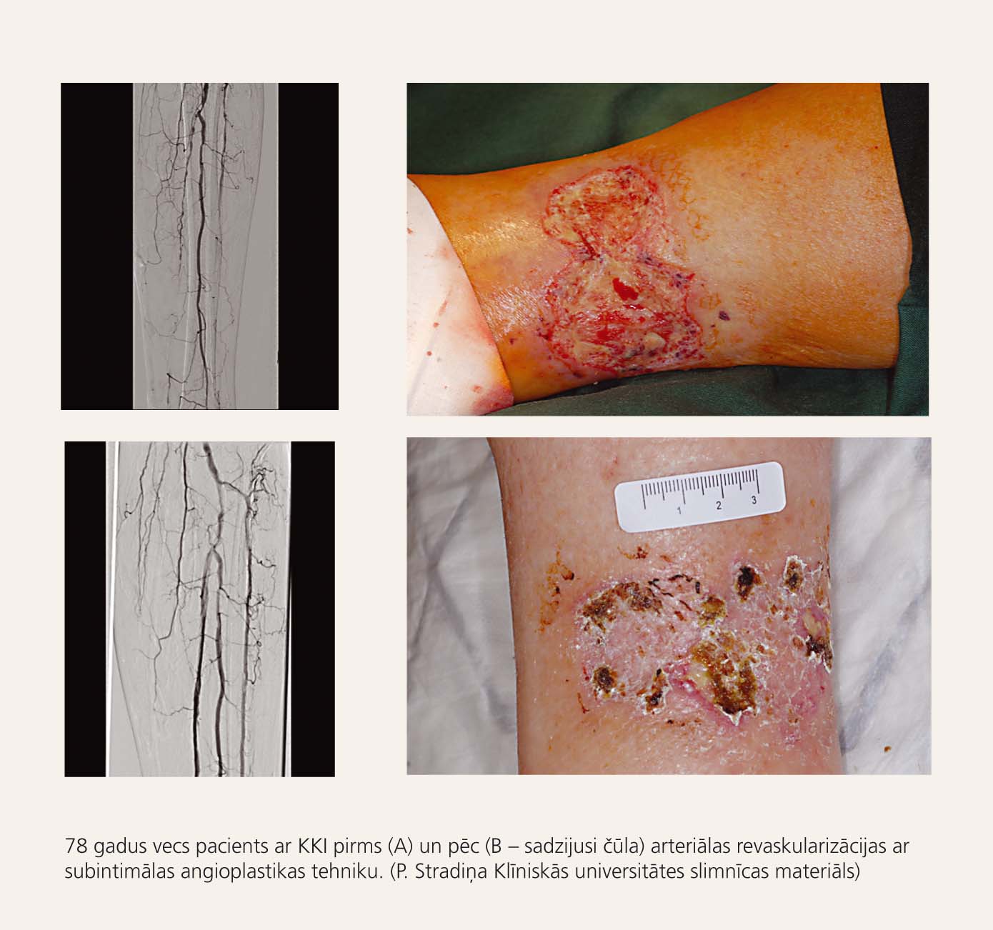 Pacients ar kritisku kājas išēmiju pirms un pēc arteriālas revaskularizācijas