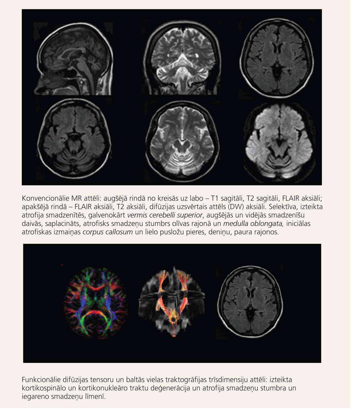 Attēldiagnostikas metodes neirogēniem OH sindromiem  (paciente ar olivopontocerebellāru atrofiju  – 38 gadi, grūti staigāt un koordinēt kustības)