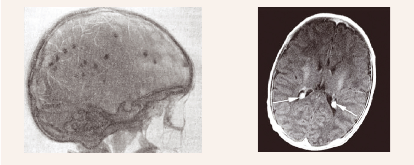 Kraniogramma (redzami petrifikāti) un MR tomogramma (apaļi perēkļi ar hiperintensīvu signālu)”