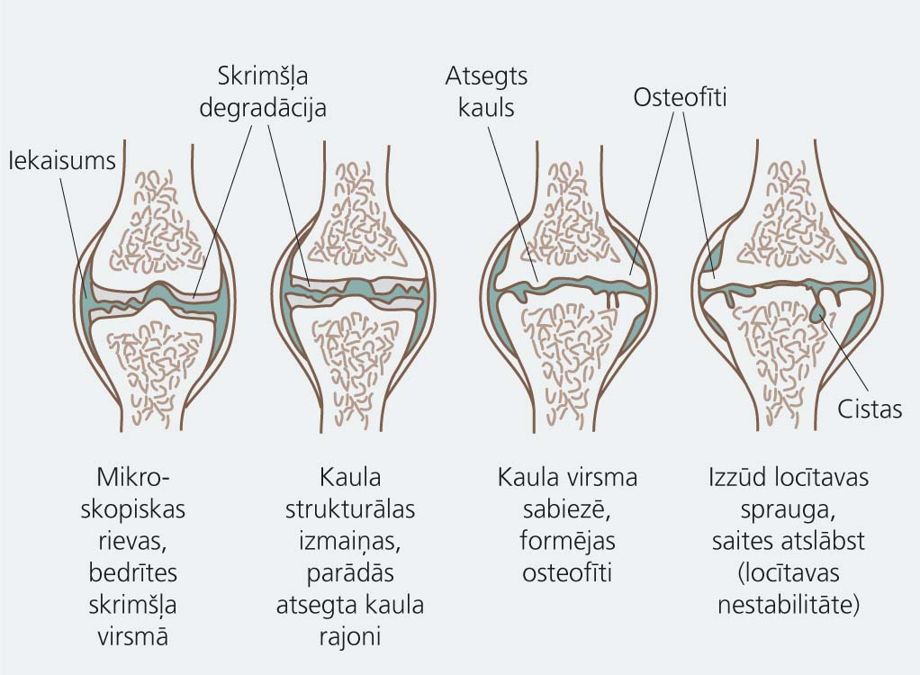 Osteoartrīta progresija