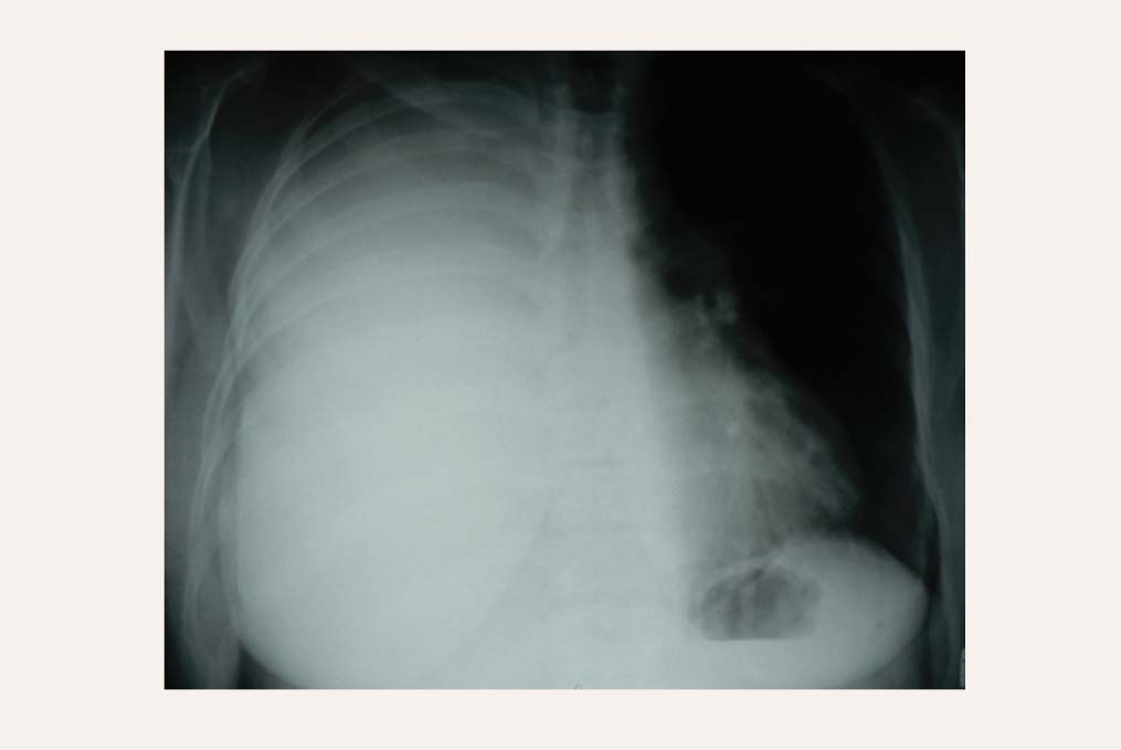 Plaušu rentgenogramma – labās puses hidrotorakss