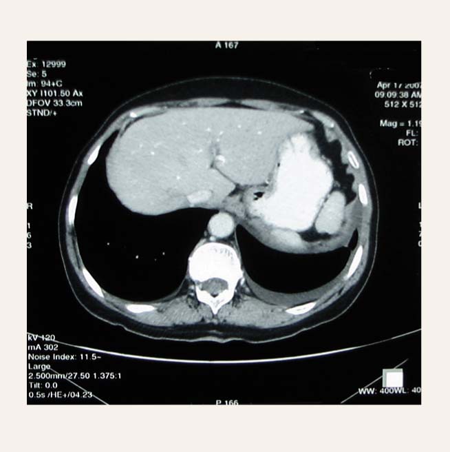 Kompjūtertomogrāfijas aina pacientam ar minimālu kreisās  puses pleirītu
