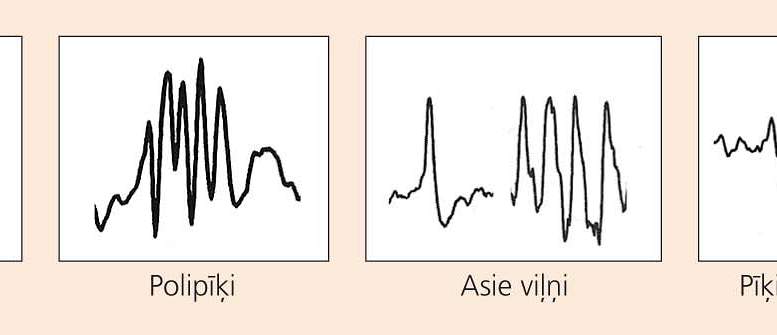 Resursi epilepsijas diagnostikā: EEG-video sinhronā monitorēšana