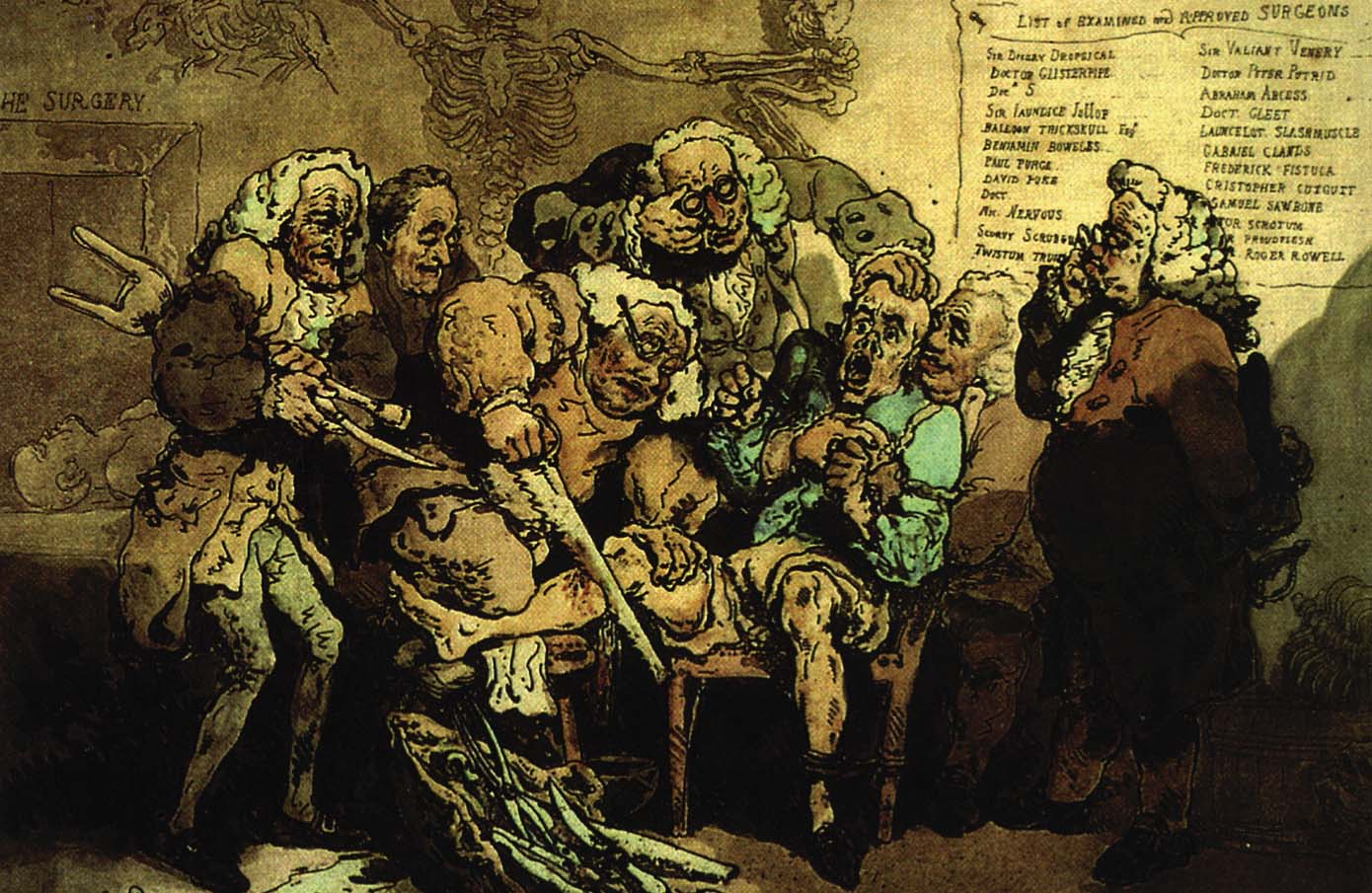 Amputācija (The amputation). 18. gadsimta ķirurgu kaislību uz amputāciju veikšanu parādījis britu karikatūrists Thomas Rowlandson, 1785. gads