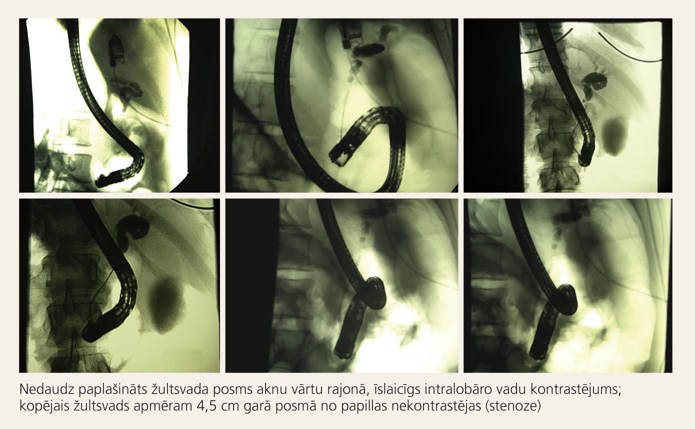 Endoskopiska retrogrāda holangiopankreatogrāfija ar papillotomiju (28.07.05)