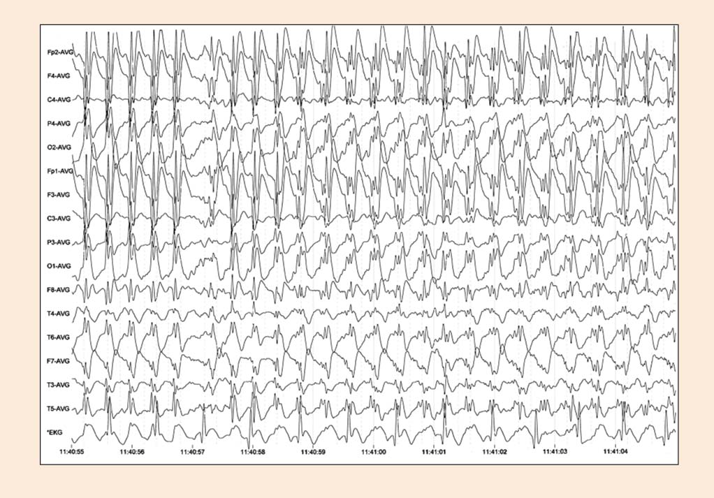 Absansu epilepsija – iktāla (lēkmes laikā) EEG