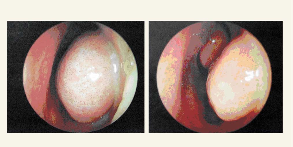 Deguna gļotāda pirms un pēc dekongestantu aplikācijas (rinoskopija)