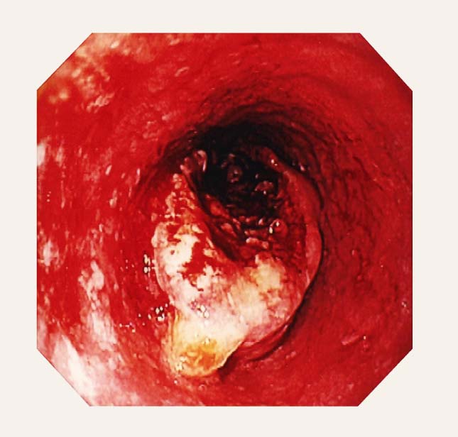Plašs, sabrūkošs tumors ar izteiktu kontakta sangvināciju (EGDS)