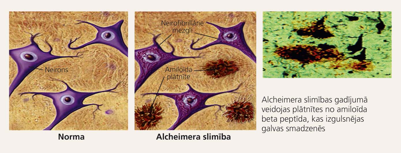 Alcheimera slimības neiropatoloģija