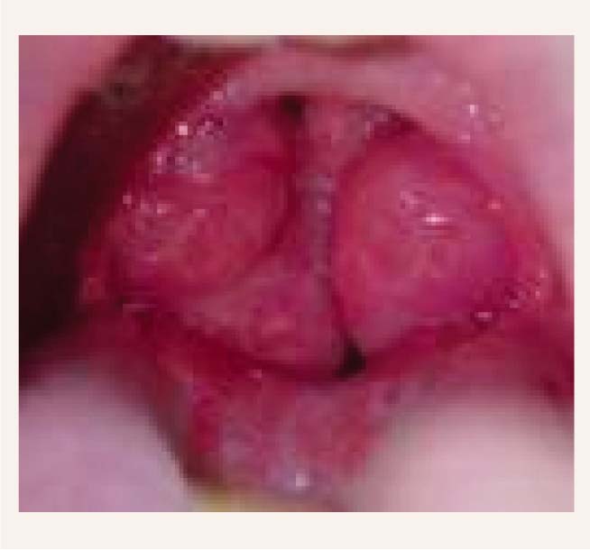 Hiperplastisks tonsilīts