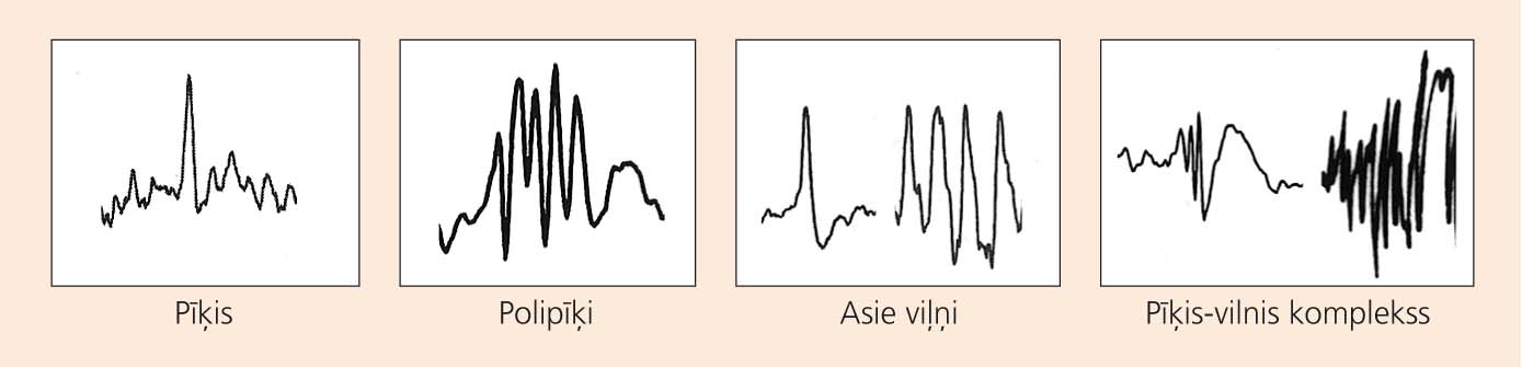 Epilepsijai raksturīgie viļņi un viļņu grupas