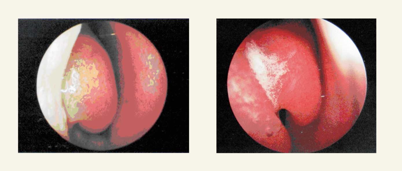 Deguna gļotāda veselam cilvēkam (pa kreisi) un pacientam  ar medikamentozu rinītu (rinoskopija)