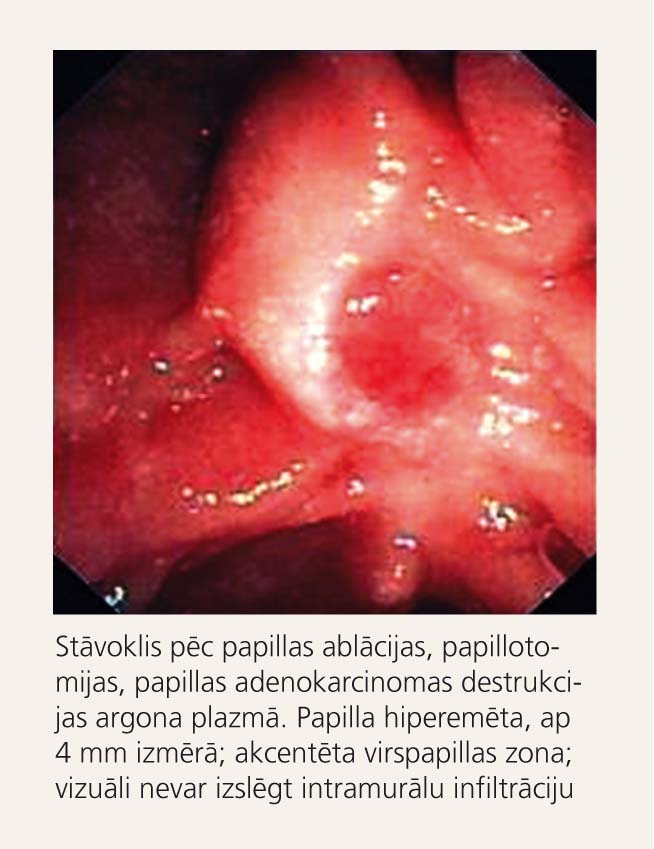 Kontroles augšējā gastrointestinālā endoskopija ambulatori (06.12.05)