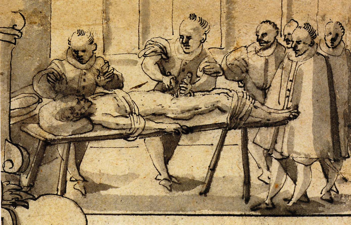 Pie sola piesietam pacientam tiek izdarīta herniotomija, uz ko nolūkojas četri ziņkārīgie. 1590. gads. (Schweizerisches Landesmuseum, Zurich)