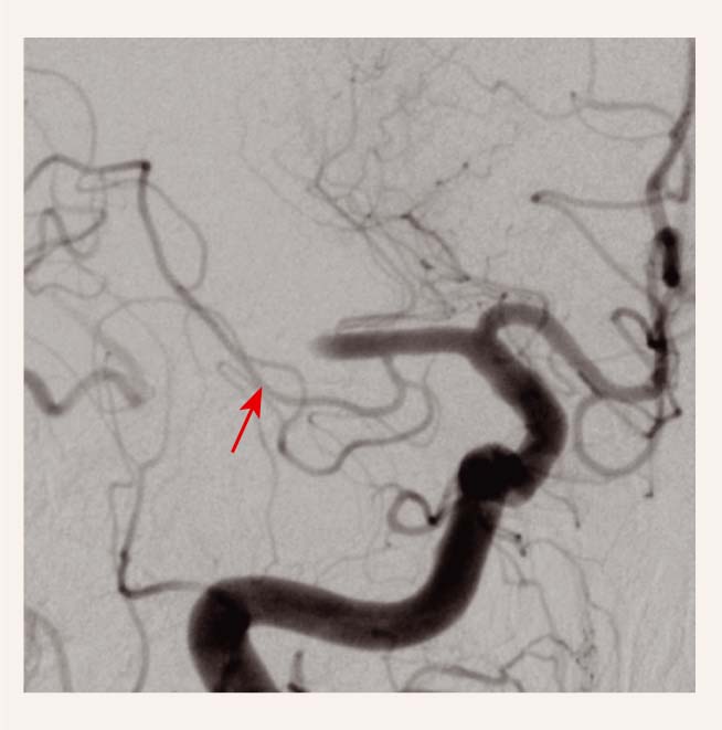 Digitālās subtrakcijas  angiogrāfija – a. cerebri media dxt M1 segmenta oklūzija