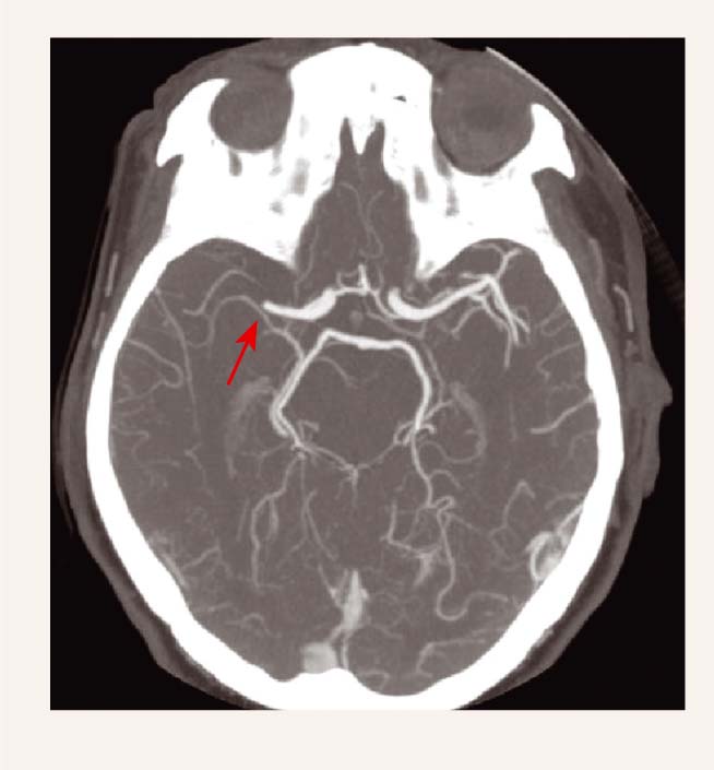 DT angiogrāfija –  a. cerebri media dxt oklūzija