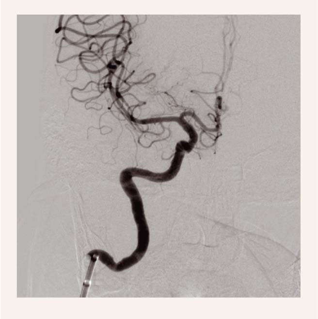 Digitālās subtrakcijas angiogrāfija – artērijas rekanalizācija pēc trombektomijas