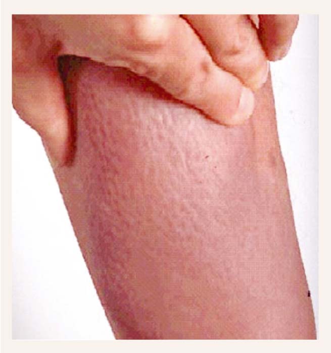 Infiltratīva dermatopātija  (pretibiāla miksidēma)