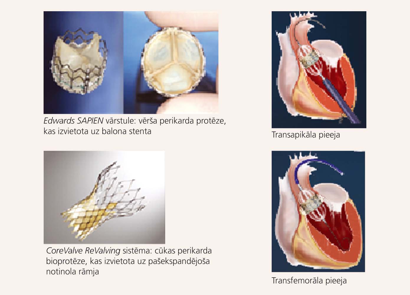 Mazinvazīvās aortas vārstuļa protēzes